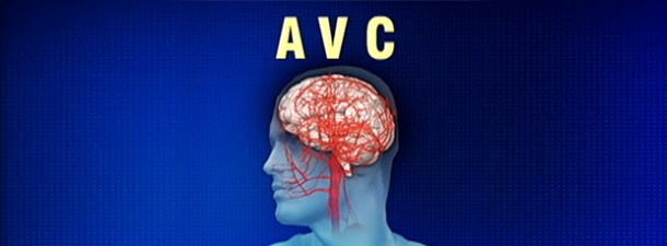 Só idosos têm AVC? Sequela é para sempre? O que você sabe sobre a doença?